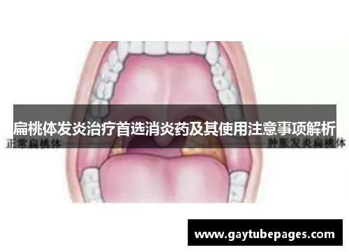 扁桃体发炎治疗首选消炎药及其使用注意事项解析